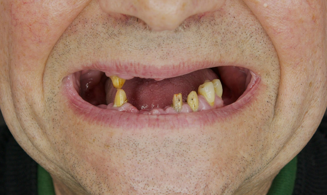 Patient with multiple missing and damaged teeth in the lower jaw before complex restoration.