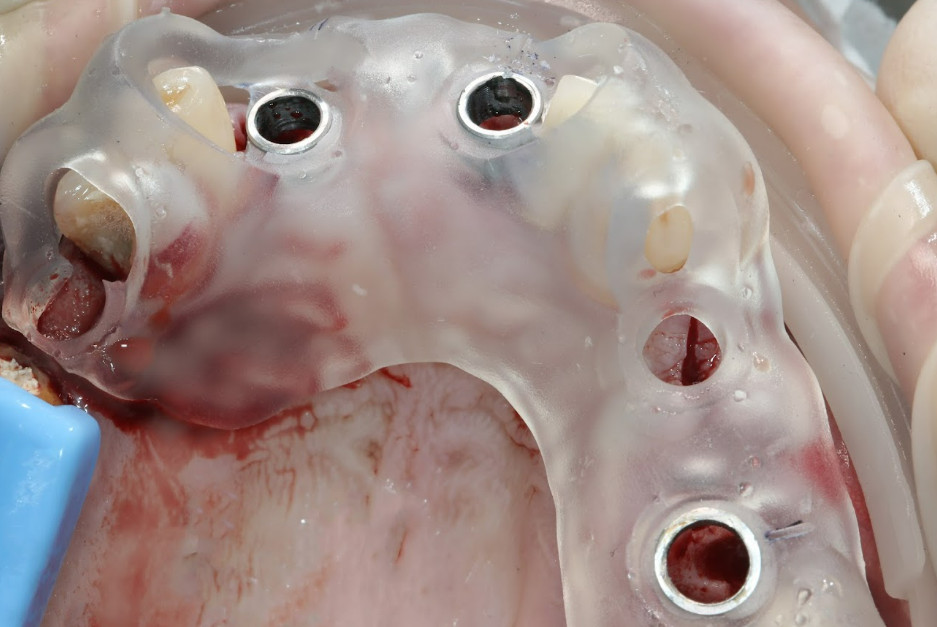 Occlusal view of a transparent surgical guide with metal sleeves seated in the mouth during implant placement.