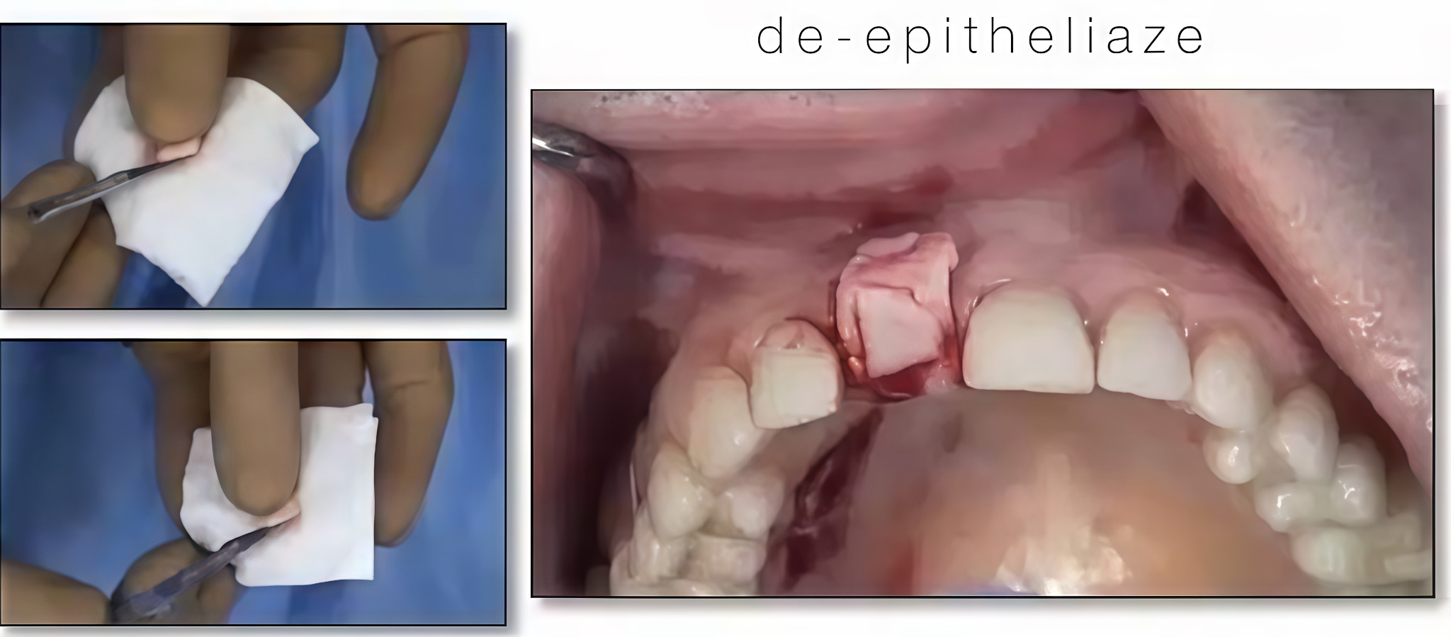 Composite image showing de-epithelialization of the connective tissue graft and positioning of the tissue fragment.