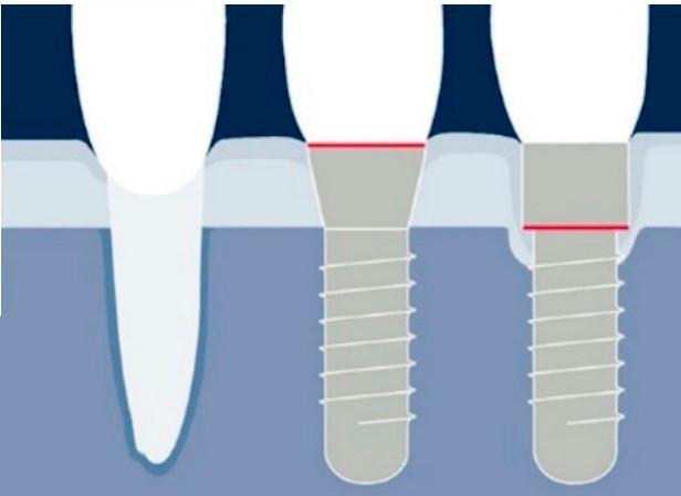 Comparison diagram showing natural tooth, bone level dental implant, and tissue level dental implant in jawbone