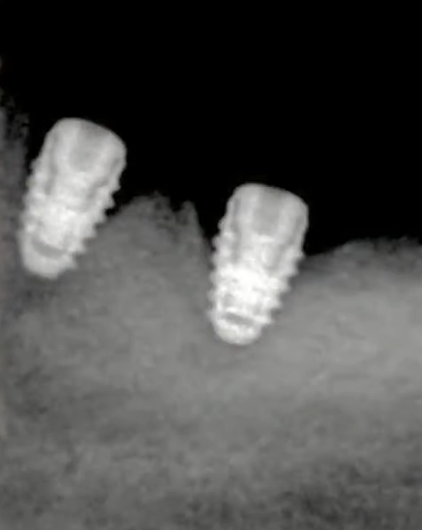 Two dental implants showing significant bone loss and poor integration after incorrect placement technique