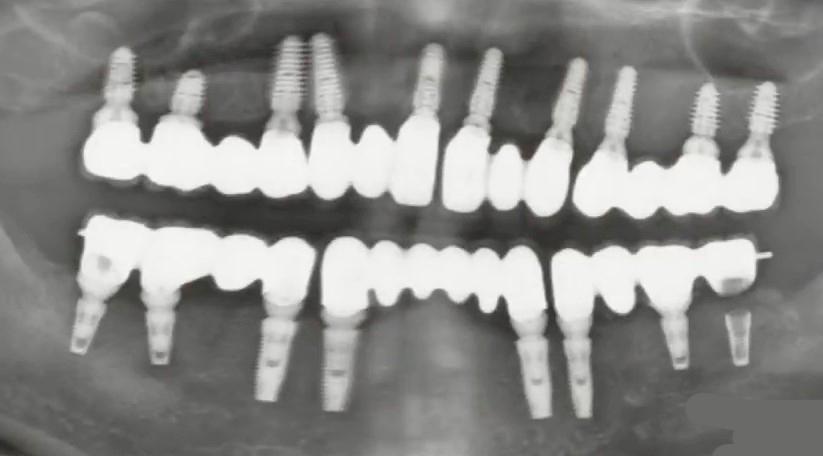 Panoramic x-ray showing multiple dental implants with bridge restoration exhibiting crown overhang