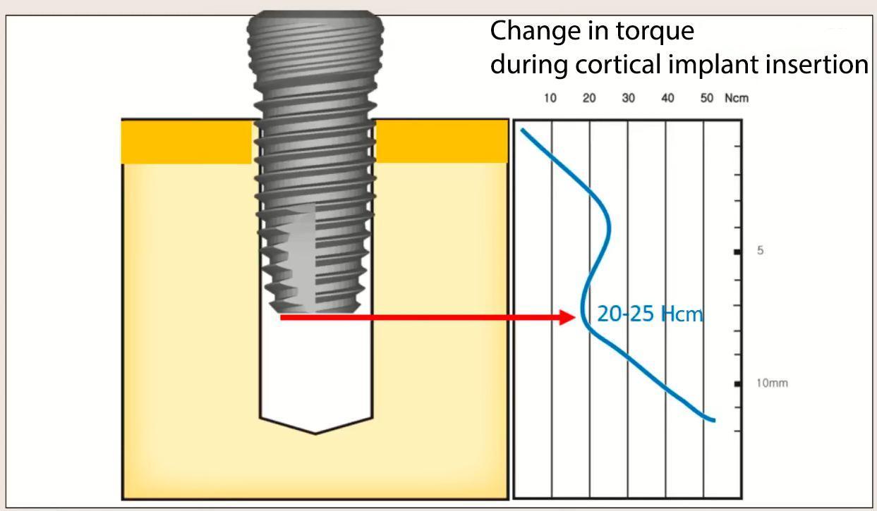 Cross-section diagram showing dental implant insertion through cortical bone with torque measurement graph