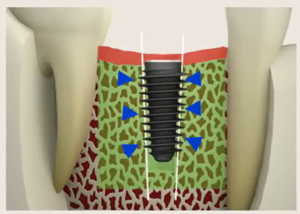 Cross-sectional diagram showing dental implant achieving primary stability in low-density cancellous bone
