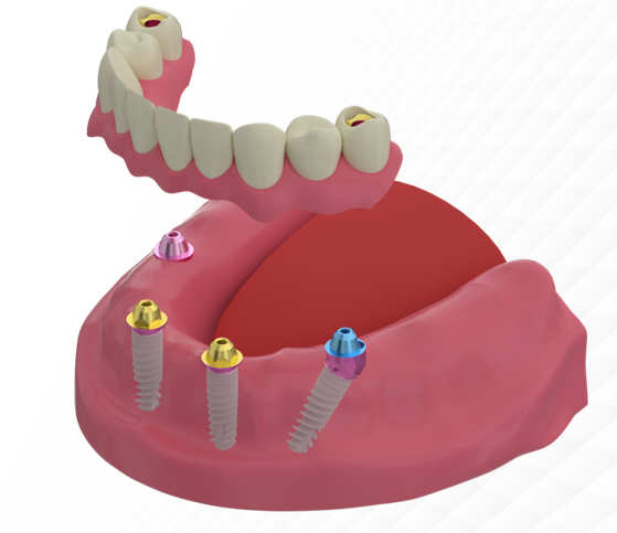 Full Arch-on-4 restoration on XGATE multi-unit abutments, 3D model