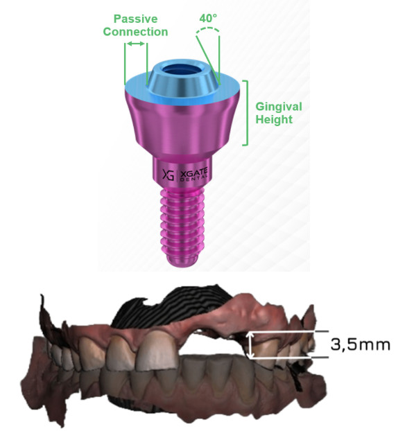 XGATE V-Type multi-unit abutment with passive connection and 3.5 mm prosthetic height