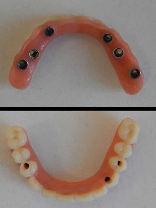Upper and lower dental implant overdentures showing metal attachment housings and prosthetic teeth
