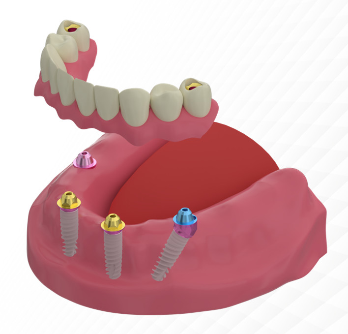 Lower jaw model showing four dental implants with color-coded abutments supporting full arch overdenture prosthesis