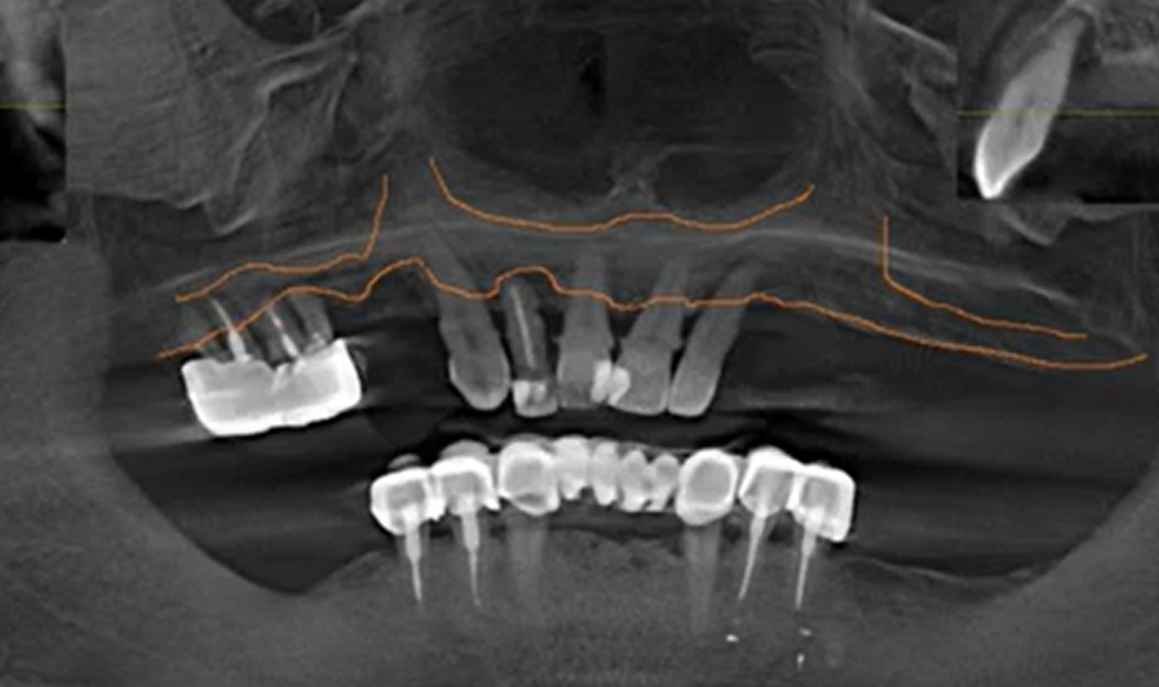 Lateral cephalometric x-ray showing maxillary bone deficiency with dental implants and missing teeth