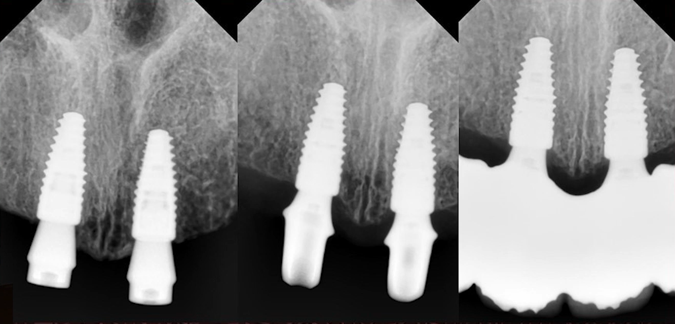 X-rays: immediately after implantation, 3 months and 12 months after implantation