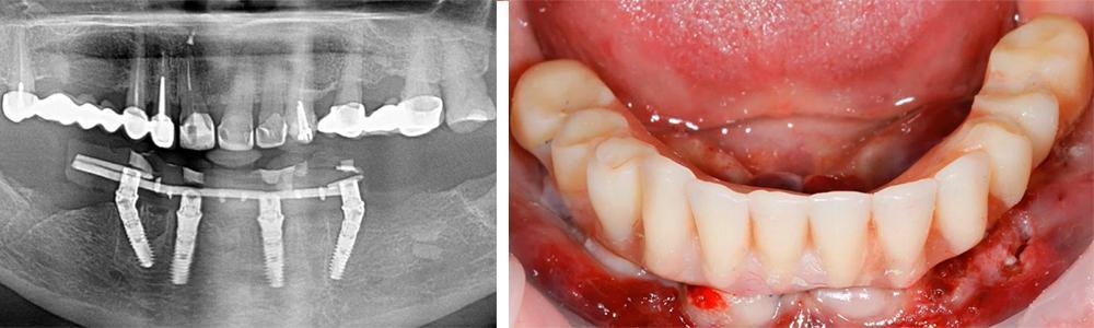 X-ray showing mandibular dental implants with temporary denture and clinical photo of worn prosthesis