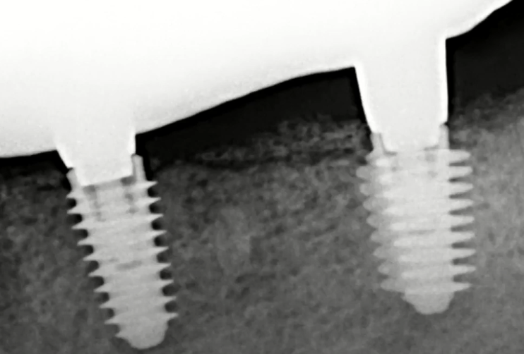 The dental technician ground down part of the interface (internal hex), otherwise the restoration would not fit