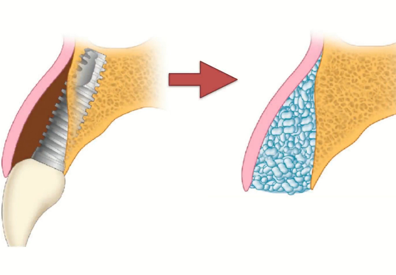 A difficult case for immediate implantation