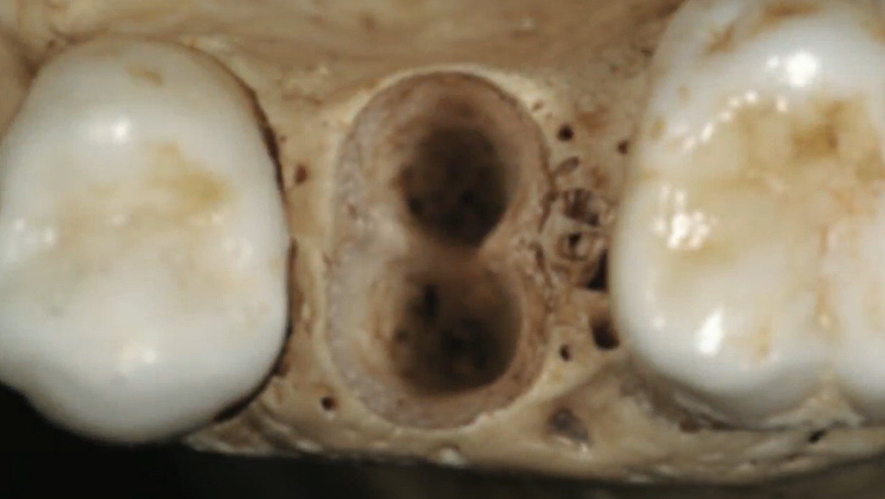 Hole after removal of a double-rooted tooth