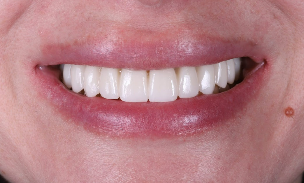 Close-up smile showing completed dental restoration with white natural-looking teeth