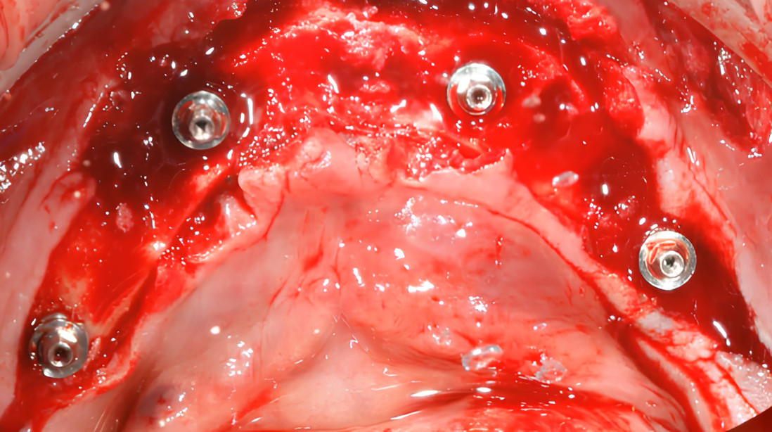 Four dental implants with healing abutments placed in lower jaw bone showing surgical site