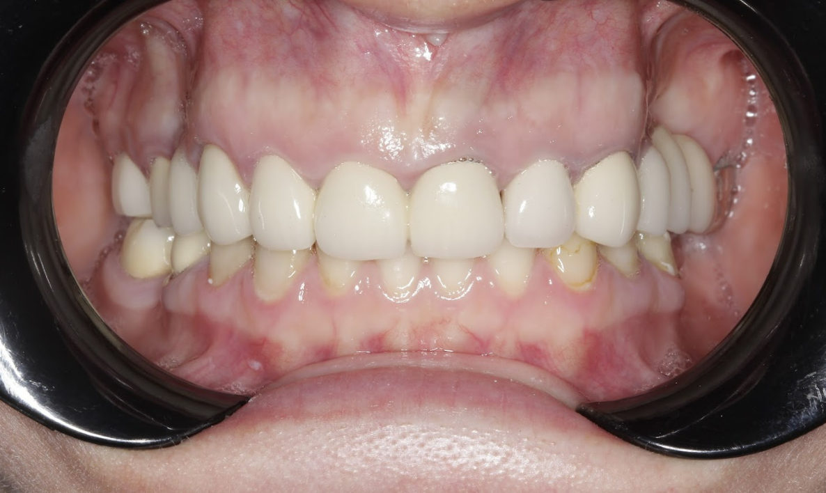 Frontal view of patient's teeth in occlusion showing bite alignment and gingival tissue