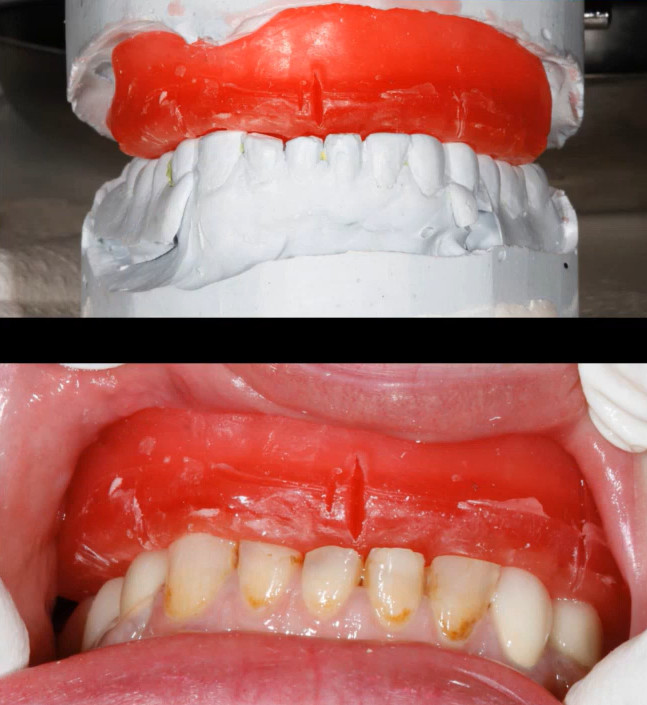 Red wax bite rim on dental cast and in patient mouth for recording interocclusal height
