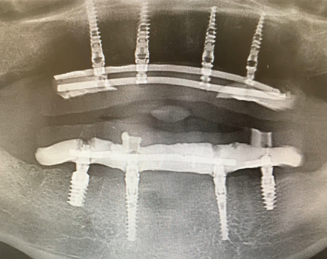 Panoramic x-ray showing full-arch dental implant restoration with metal framework and multiple implant posts