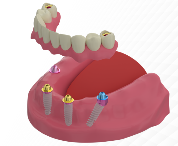 3D model showing four dental implants with angled posterior placement supporting full arch restoration