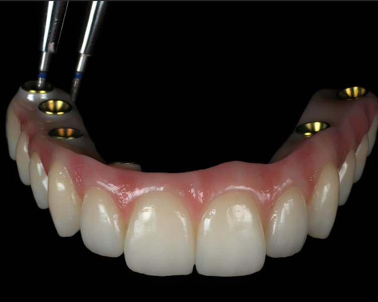 Maxillary full‑arch prosthesis for screw retention on multi‑unit abutments