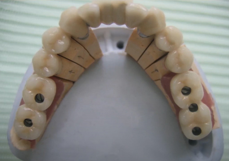 Full-arch restoration on 5 implants, one of which is placed between the positions of the teeth 6 and 7