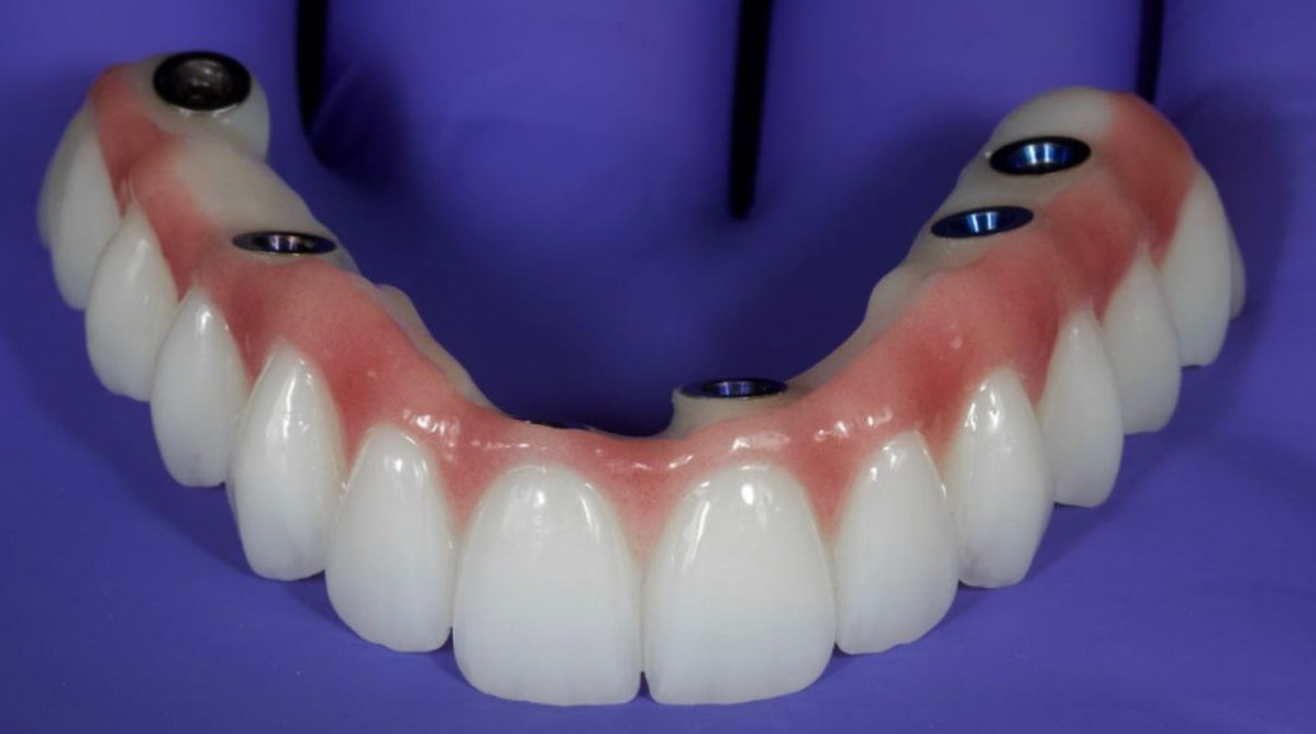 Intaglio view of a monolithic zirconia full-arch bridge with multiple screw access channels.
