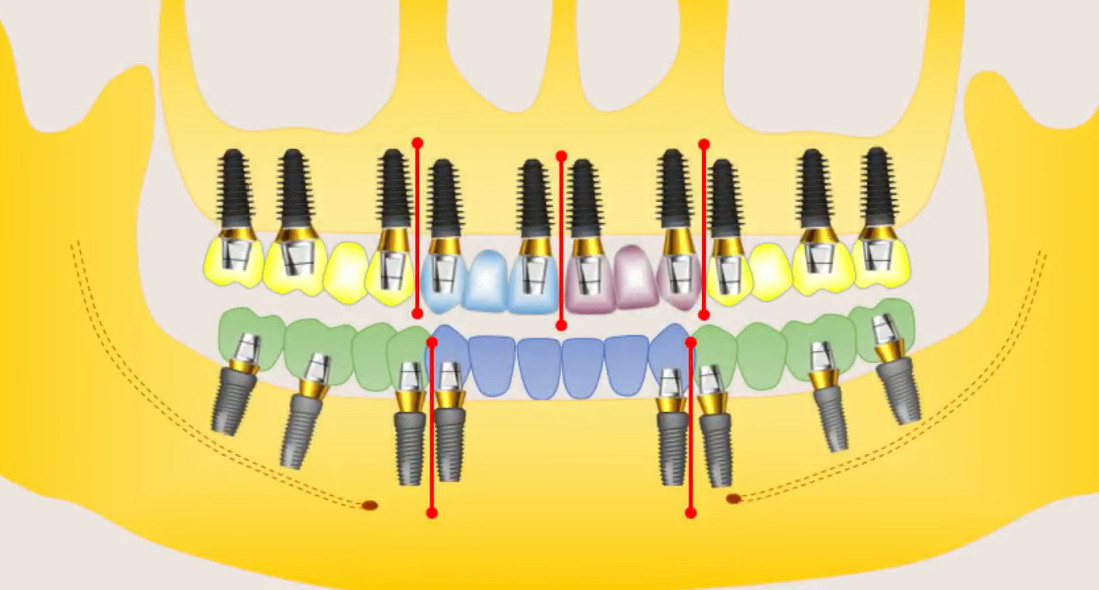 3D diagram showing upper and lower jaw dental implant placement with bridges and anatomical segmentation