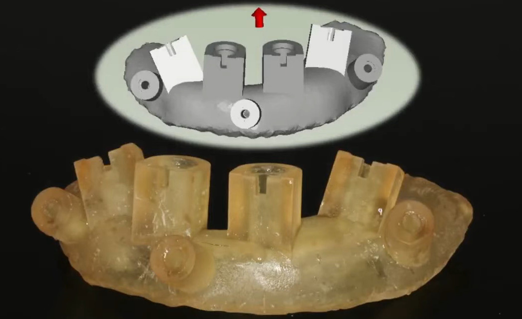 A fully guided surgical template controls not only the depth and angle of implant insertion but also the rotational position of the internal interface.