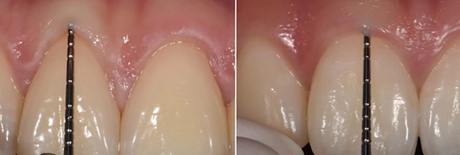 Dental probe assessing gingival thickness showing thin biotype with visible probe versus thick biotype with obscured probe