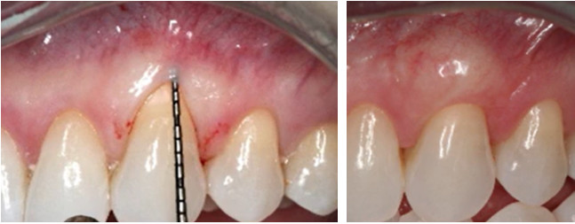 Before and after photos showing increased attached gingiva thickness around anterior teeth using soft tissue grafting