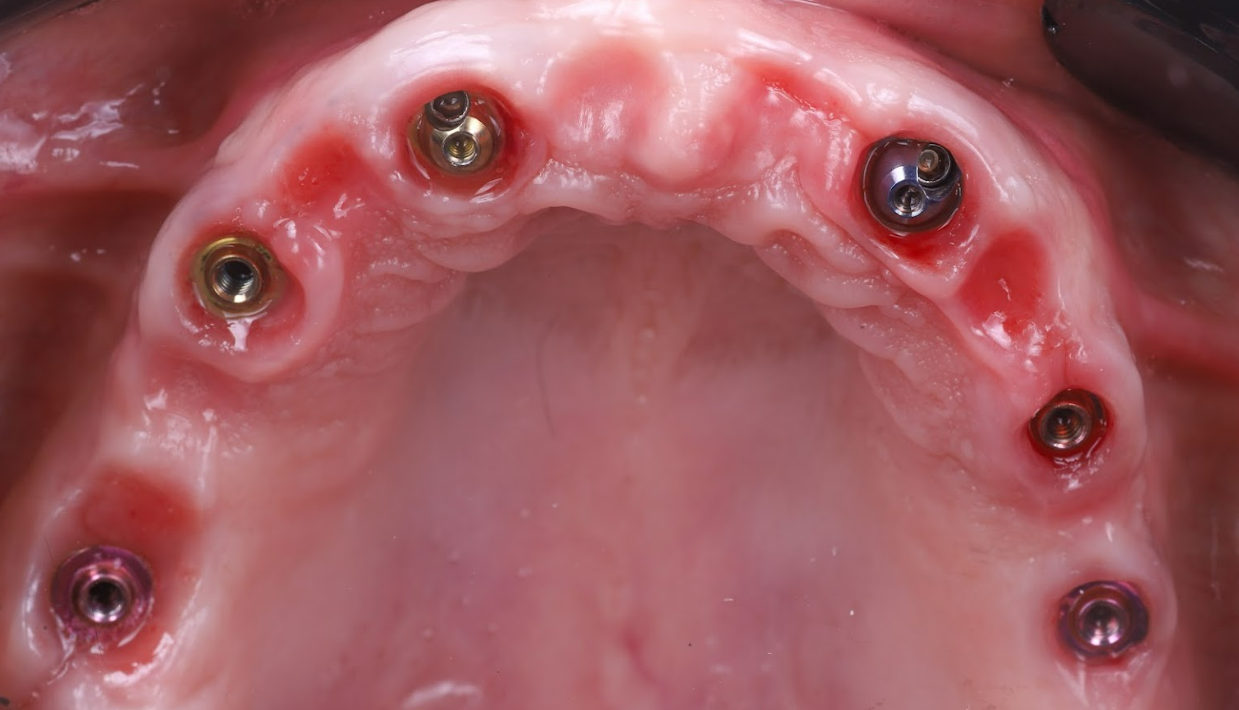 Occlusal view of six dental implant healing abutments installed in edentulous upper arch