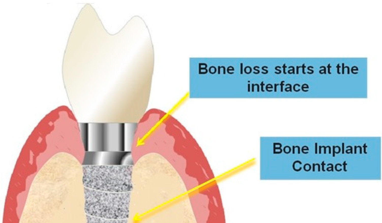 Cross-sectional diagram showing dental implant surface interacting with surrounding bone tissue