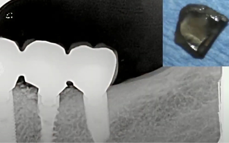 Implant fracture – requires removal and replacement