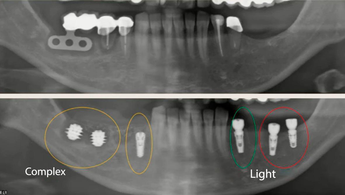 Implant placement in the posterior mandible: a simple case (quadrant 3) versus