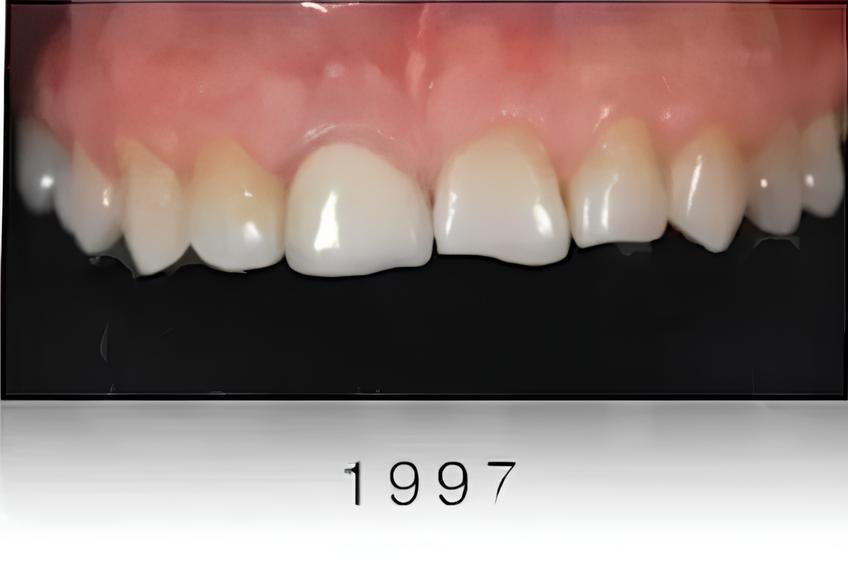 Close-up of the anterior teeth with a crown on tooth 11 and a chipped incisal edge on tooth 12.