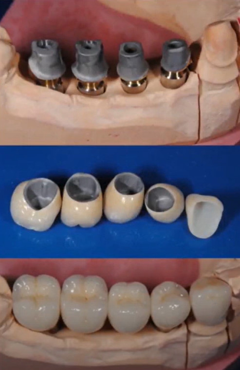 Custom abutments and crowns manufactured with the highest precision