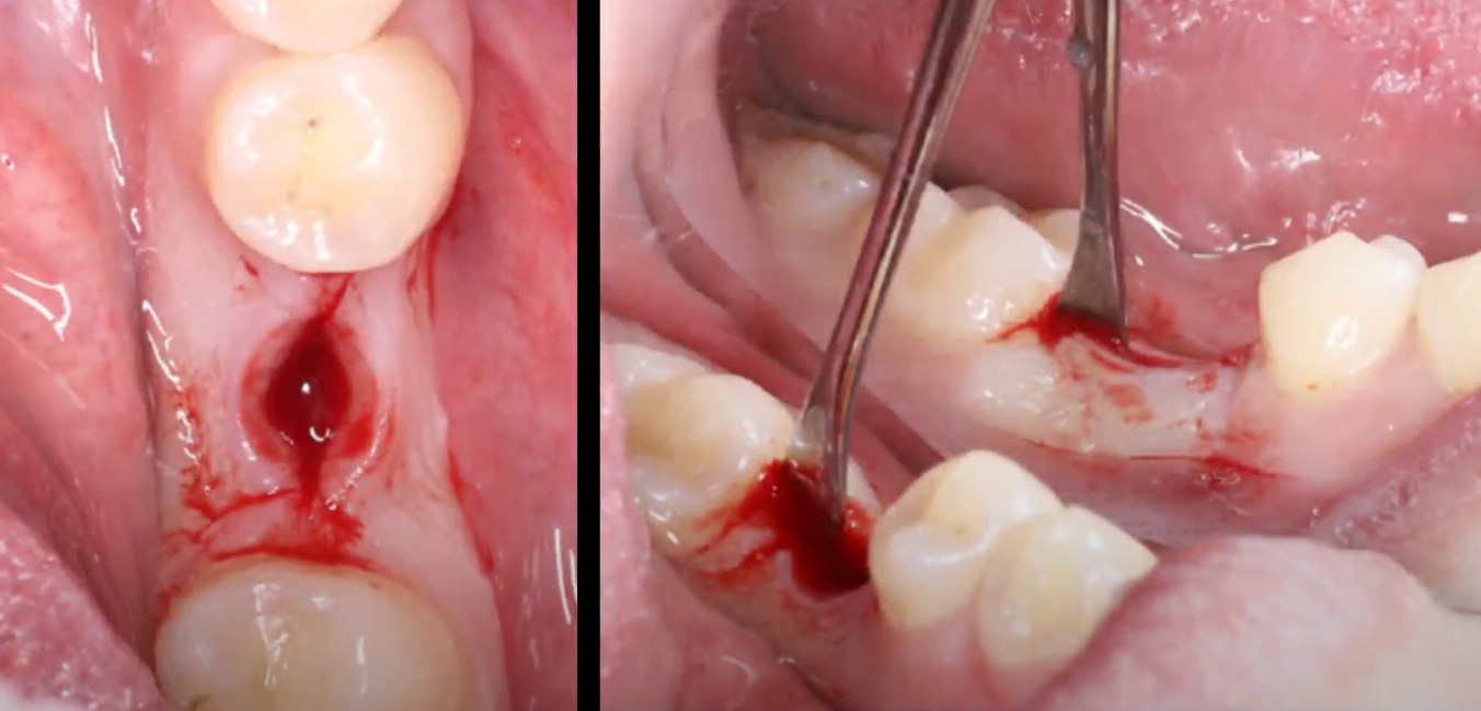 A longitudinal incision of the gingival cuff