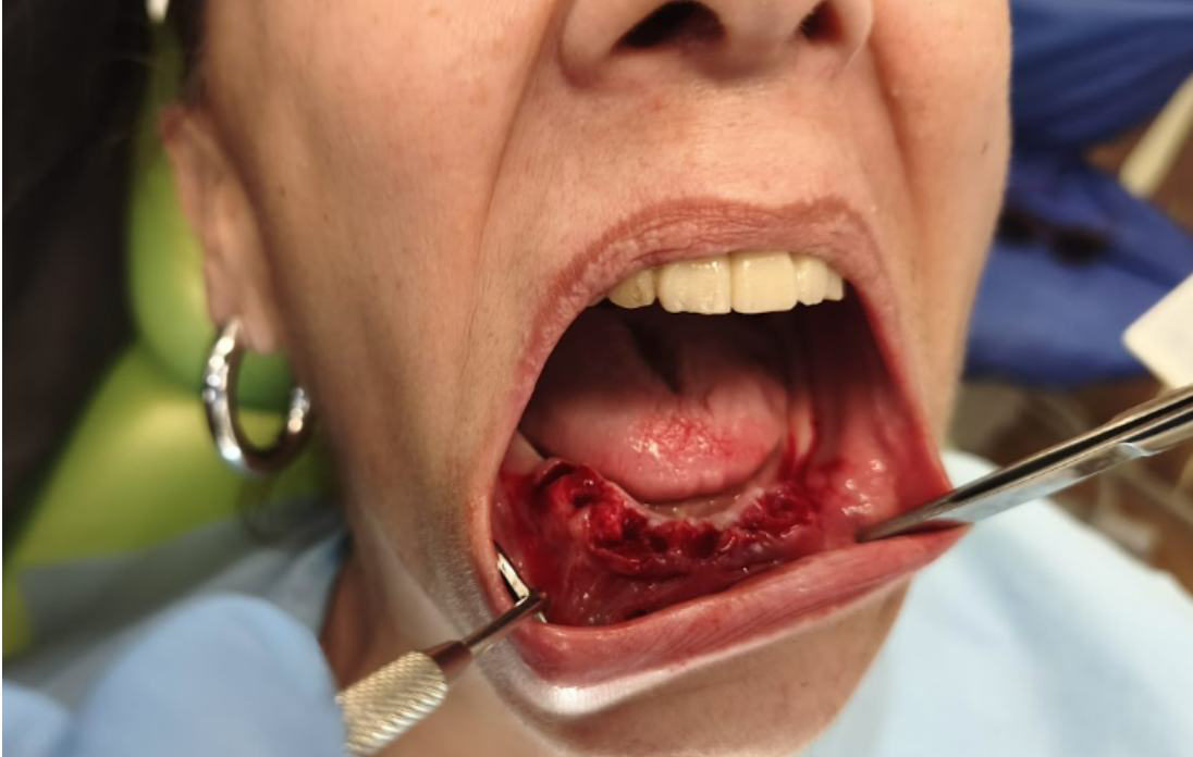 Occlusal view of the mandible immediately after atraumatic extractions.