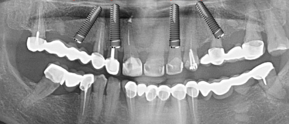 Panoramic radiograph showing tilted maxillary implants for full-arch restoration.