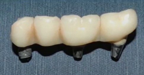 Screw-retained bridge with implant analogs