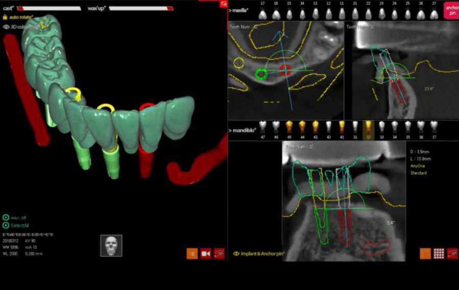 Part of the workflow: modeling the prosthesis taking into account the gingival height and correcting the location of the implants YouTube / Dr. Kamil Khabiev / Dental Guru Academy