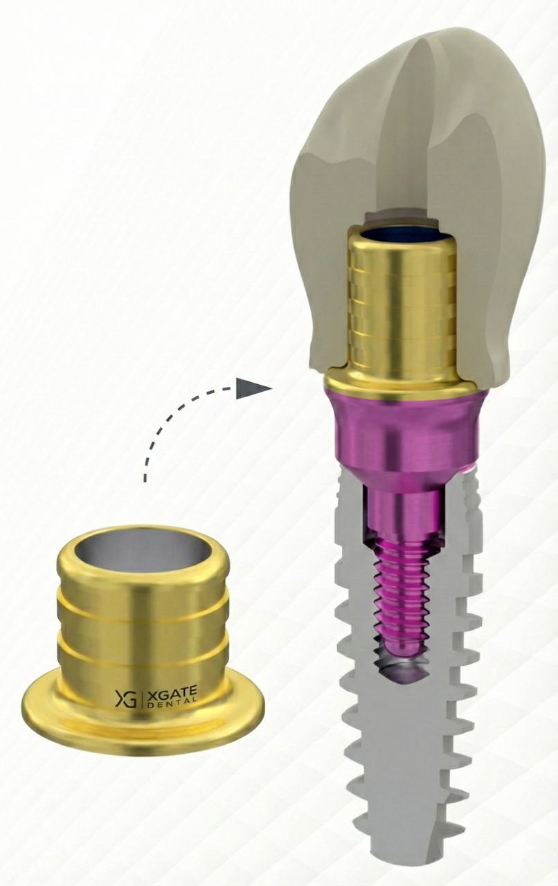Exploded view of dental implant multi-unit abutment system with gold components and prosthetic crown