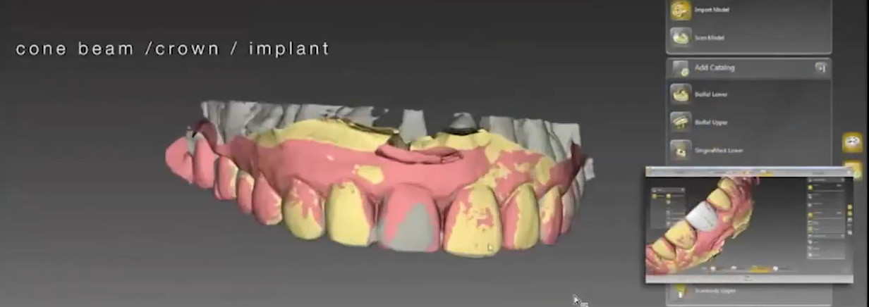Digital overlay combining CBCT data, tooth roots, and soft tissue contours for treatment planning.