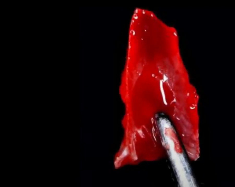 Extracted palatal fragment of the root of an affected tooth