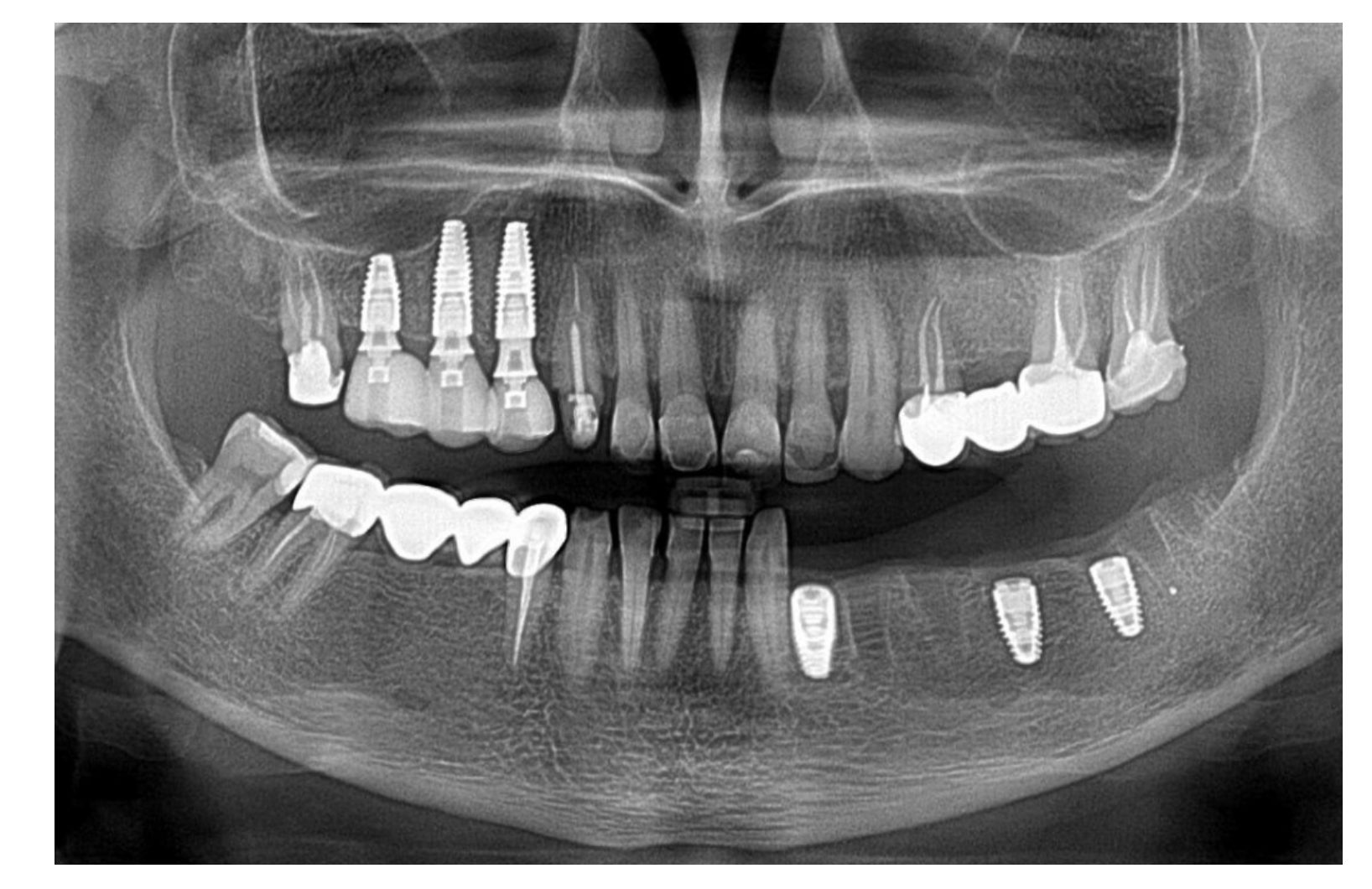 Panoramic radiograph showing dental implants and mixed prosthetic restorations across both jaws.