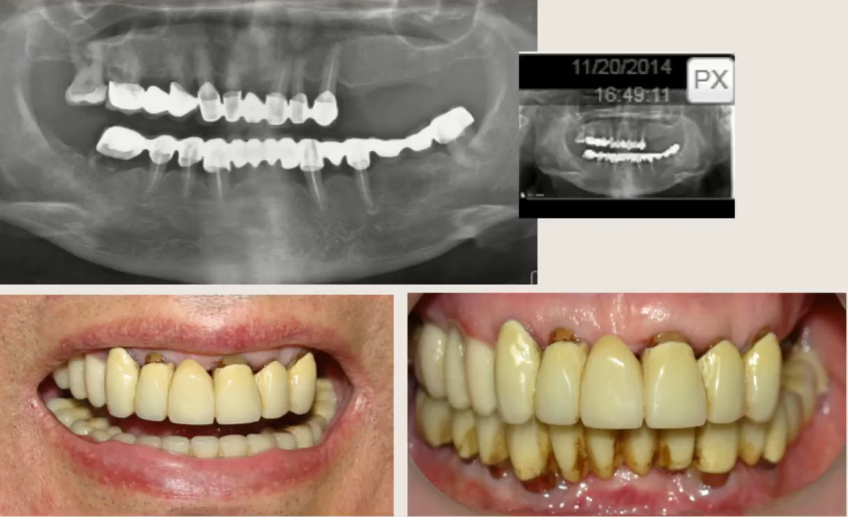 Panoramic x-ray showing dental implant supported prosthesis with before and after clinical photos