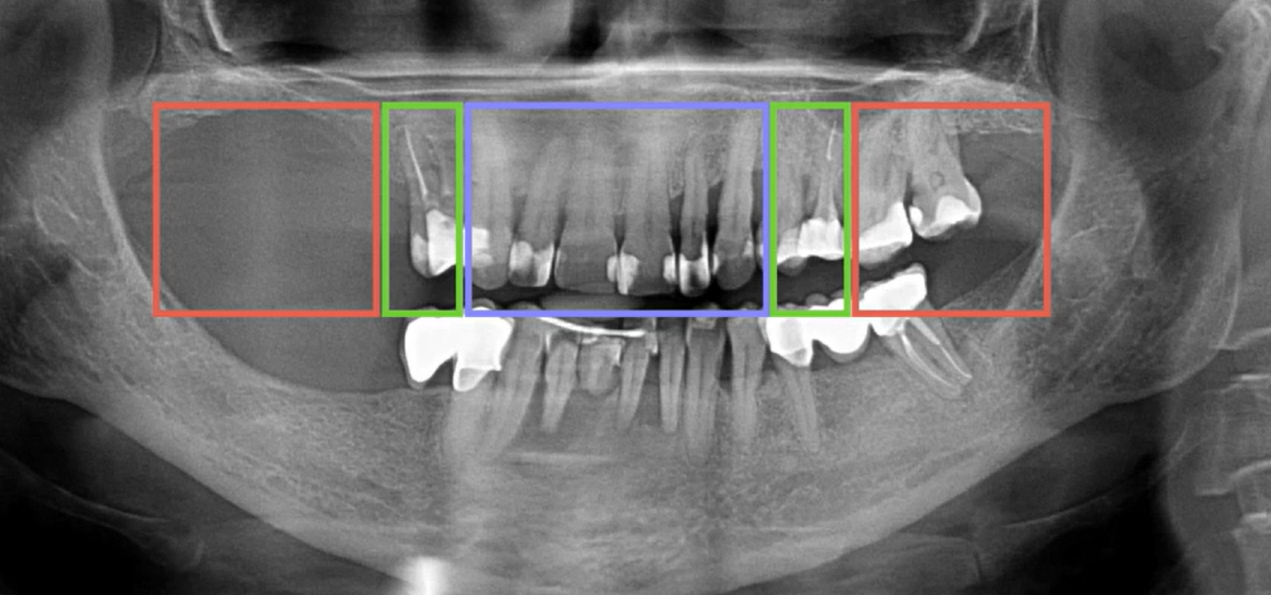 Panoramic dental X-ray showing jaw with color-coded zones marking areas for immediate full-arch restoration implants planning