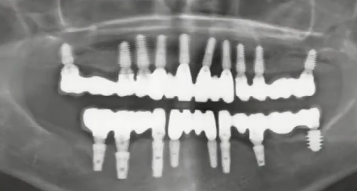 Panoramic x-ray showing multiple dental implants in upper and lower jaw with attached prosthetic restorations