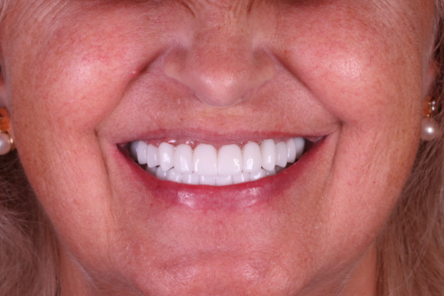 Final smile of the 57-year-old patient after complete maxillary rehabilitation with a permanent zirconia bridge, showing a natural smile line.